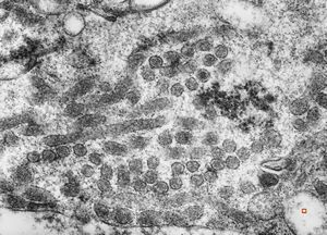 M,2y. | viral particles ? in hepatocyte